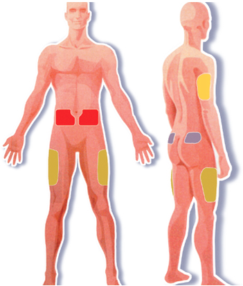 BD: Insulin Injection Sites