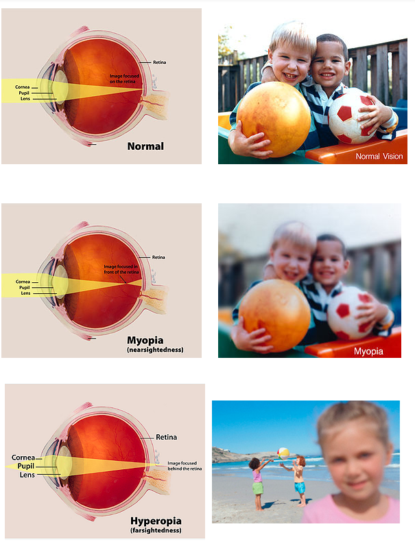 Normal vs Myopia vs Hyperopia