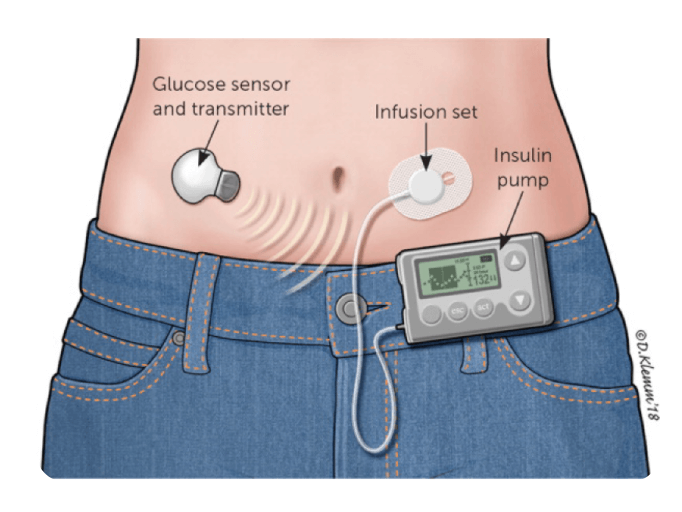 After a few months of work I have finally created insulin pump underwear :  r/diabetes_t1