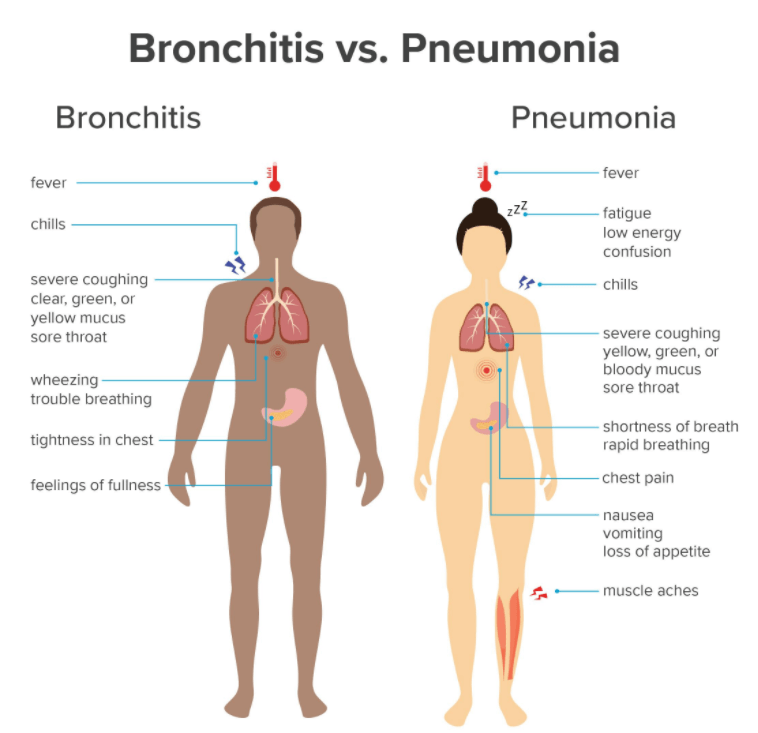 Bronchitis vs Pneumonia