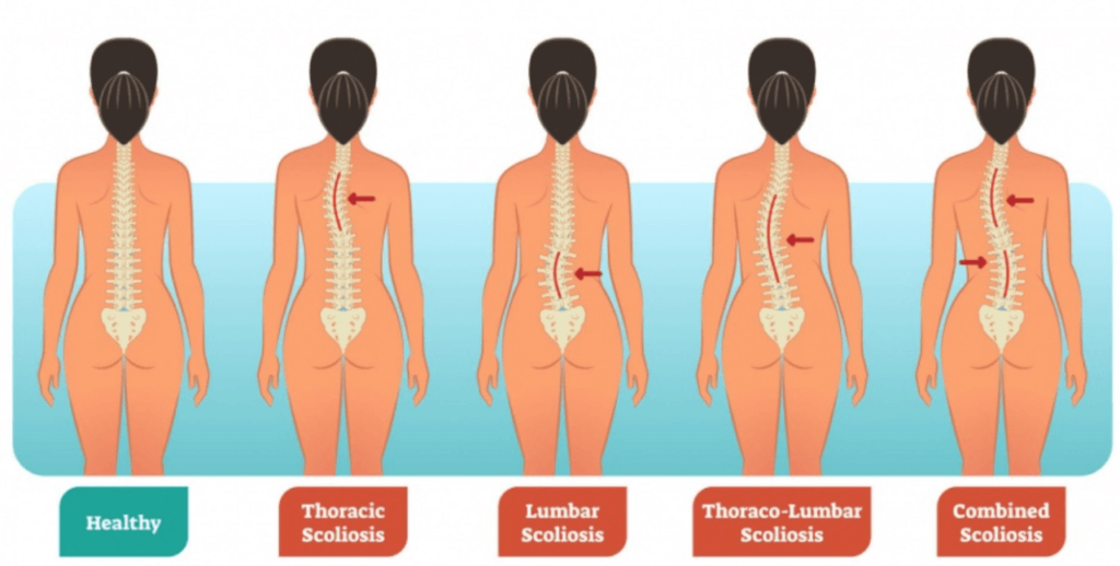 Types of Scoliosis