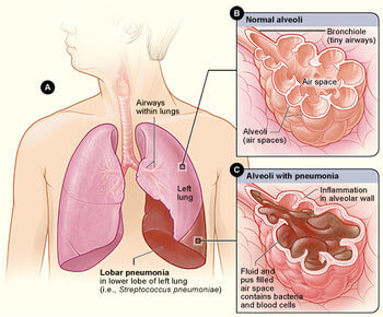 Fluid buildup in the lungs is a part of pneumonia.