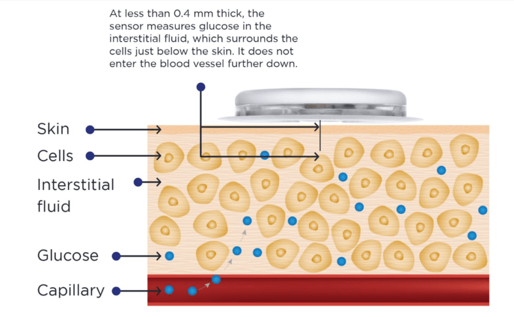 CGM Sensor Placement