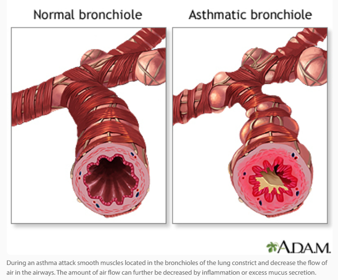 Asthma in Children
